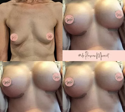 Implant mamar
