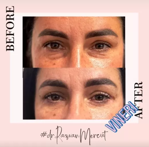Blefaroplastie inferioară înainte și după