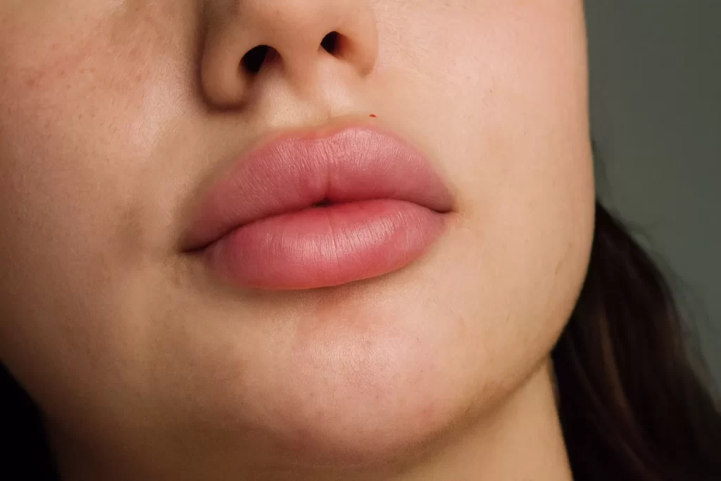 Recuperarea după Butterfly Lips – ce trebuie să știi pentru o vindecare rapidă