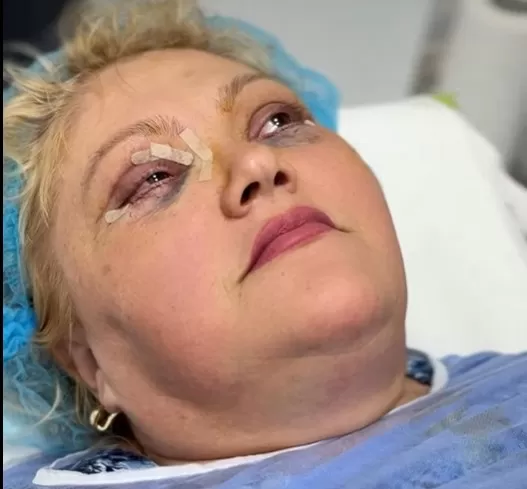 imediat dupa operatia de blefaroplastie