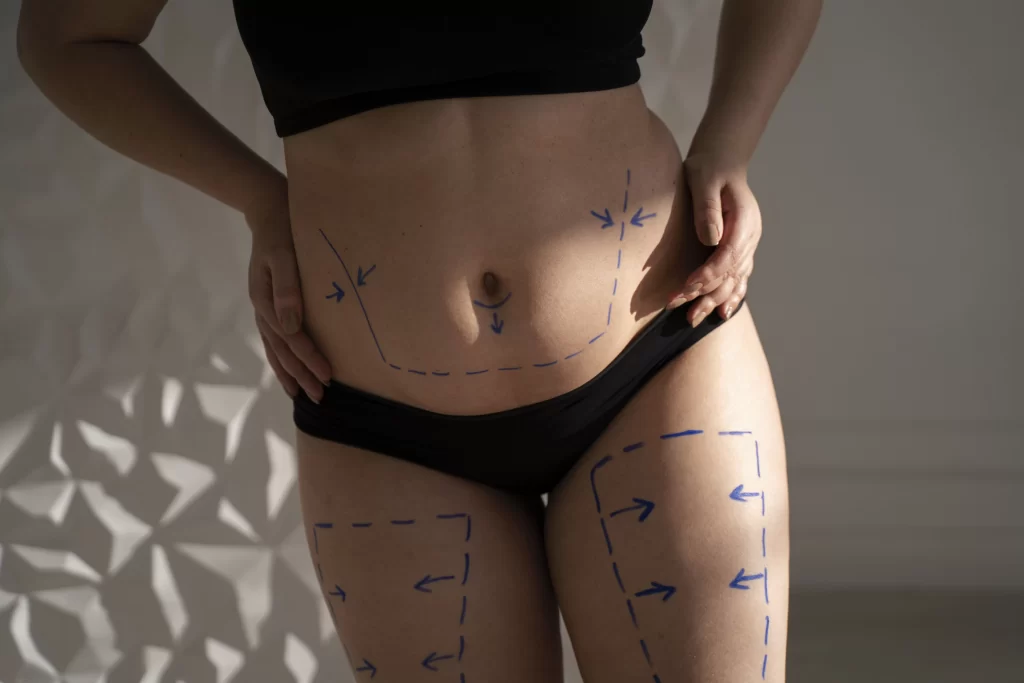 abdominoplastie