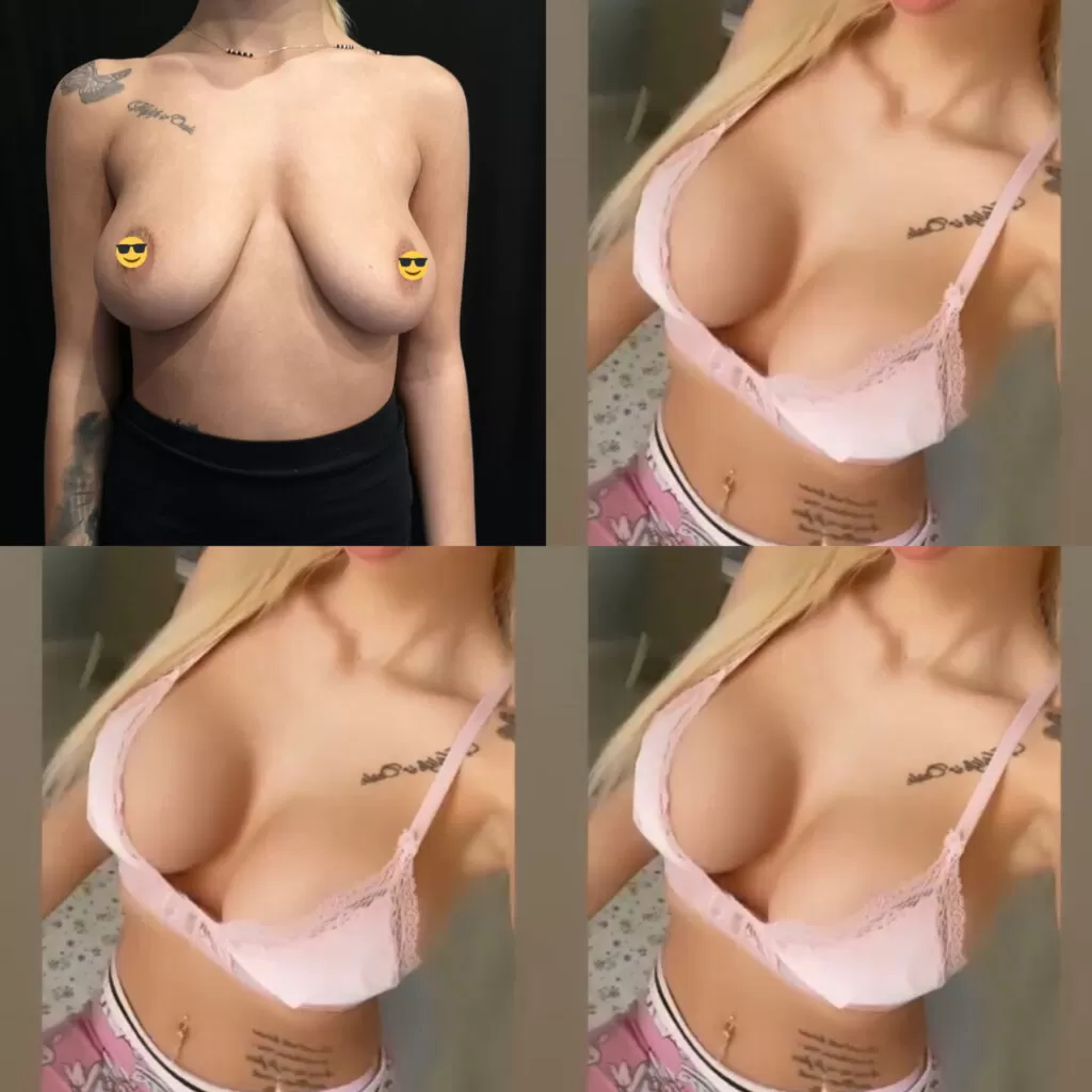 Implant silicon motiva dr razvan mercut before and after