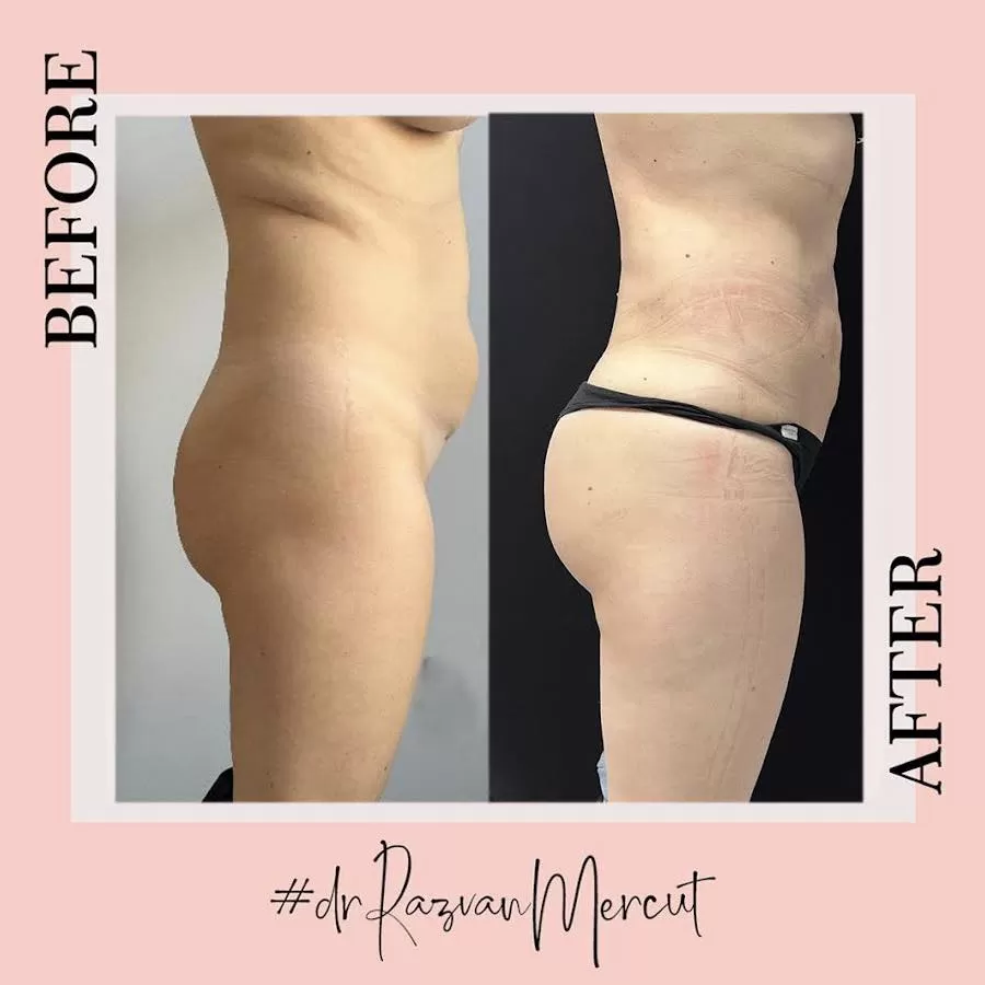 bbl before and after