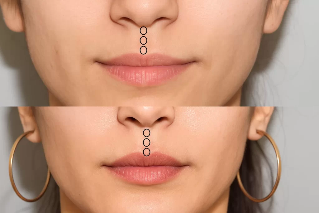Lip Lift – ce este, cine este candidatul potrivit și cum decurge recuperarea