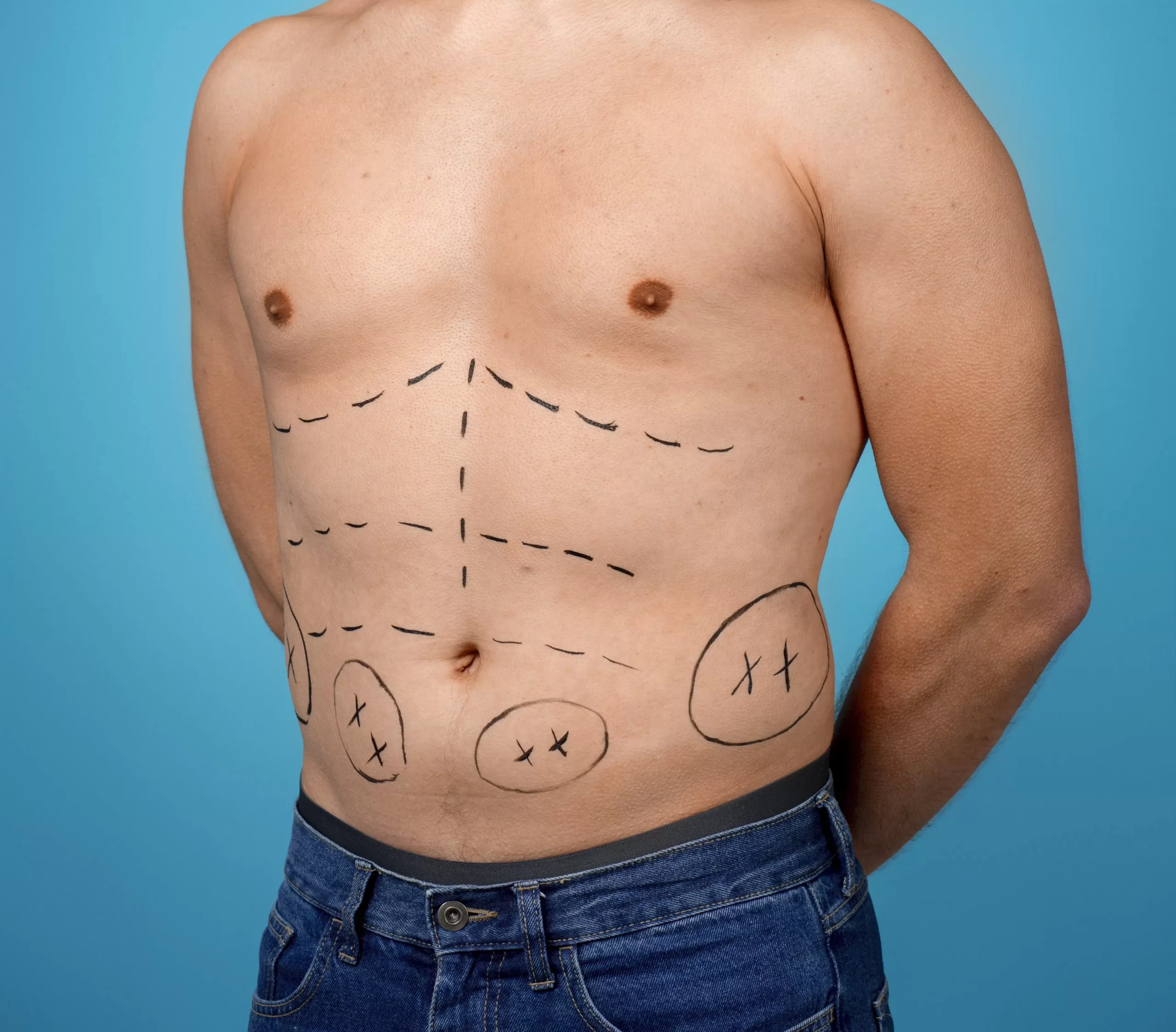 Liposucția abdominală la bărbați – Trendul anului în chirurgia estetică masculină
