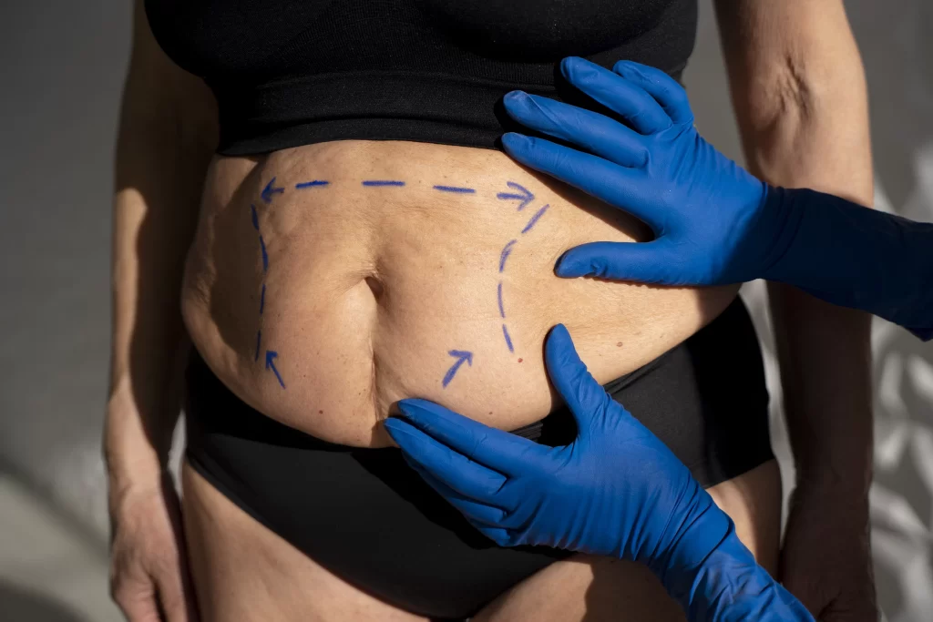 abdominoplastie tummy tuck