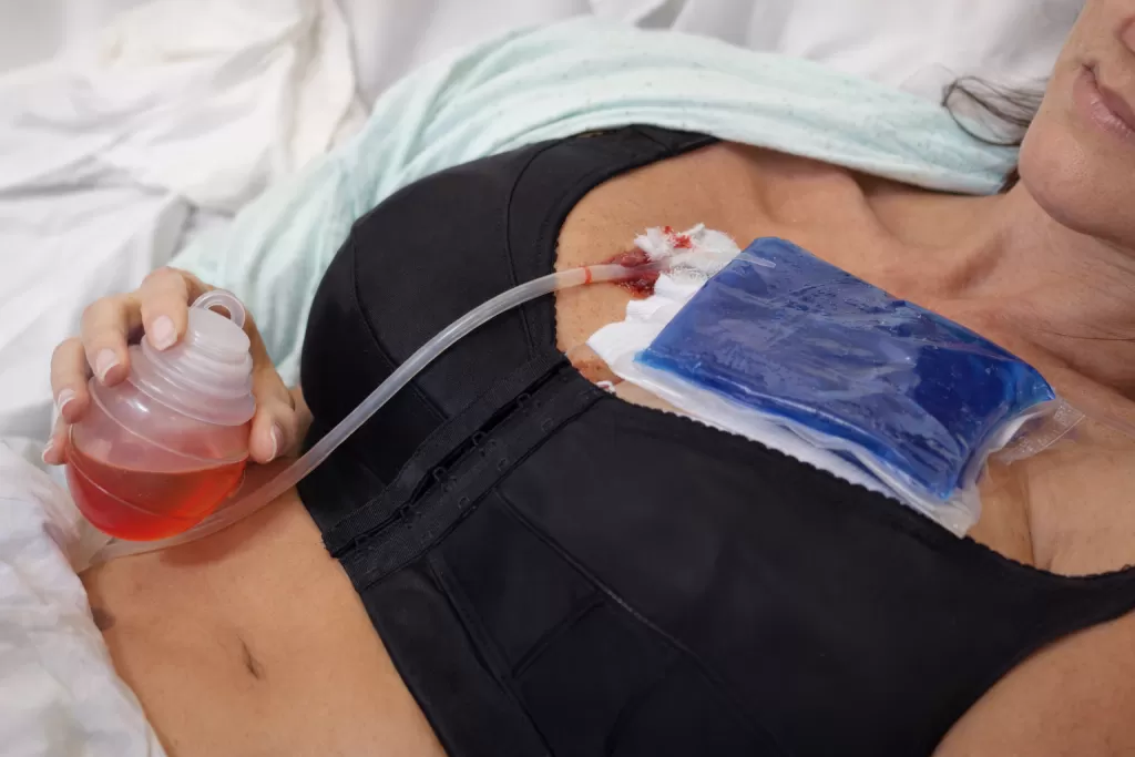Tubul de drenaj dupa Implant Mamar imagine reprezentativa
