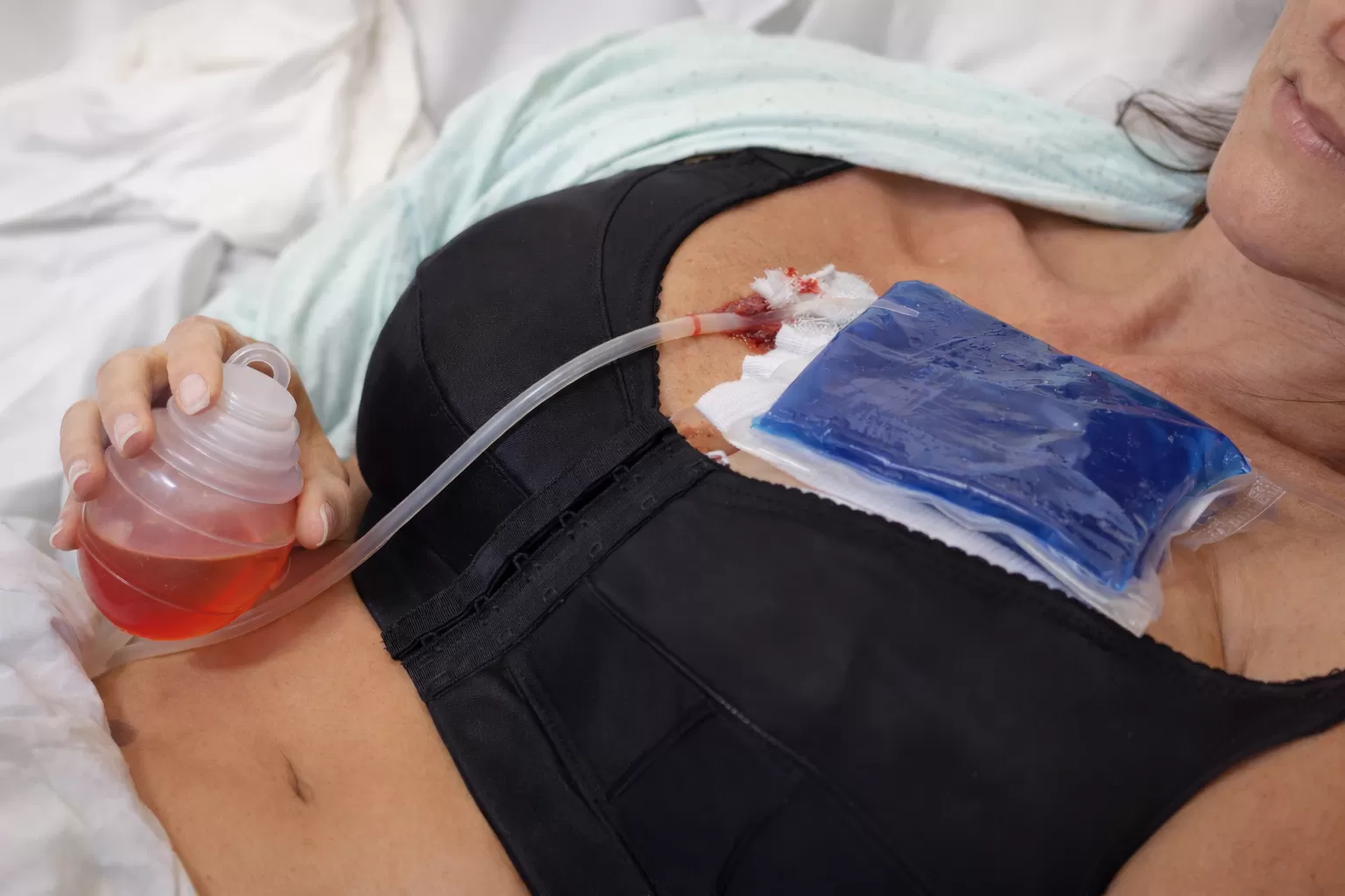 Tubul de drenaj dupa Implant Mamar imagine reprezentativa